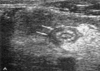 Các xét nghiệm để chẩn đoán bệnh viêm ruột thừa