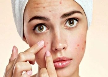 Những loại mụn tuyệt đối không được nặn kẻo nguy hiểm tính mạng